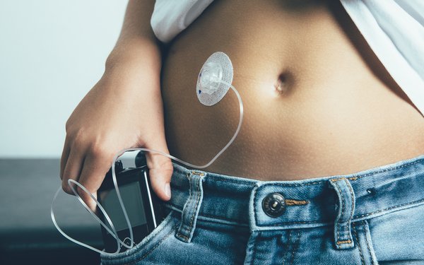 Zu sehen ist die K?rpermitte einer Person, sie steckt eine Insulinpumpe in die Hosentasche, der Katheterschlauch klebt neben dem Bauchnabel.