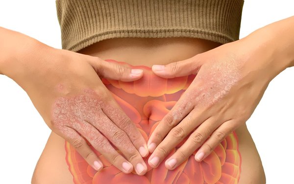 Hände mitt Schuppenflechte berühren einen Bauch mit Darstellung des Darmes