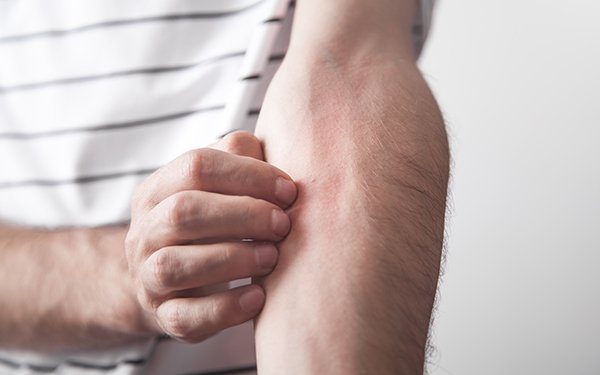 Oberk?rper einer Person mit wei?-schwarz gestreiftem Oberteil, die sich am linken Oberarm kratzt.