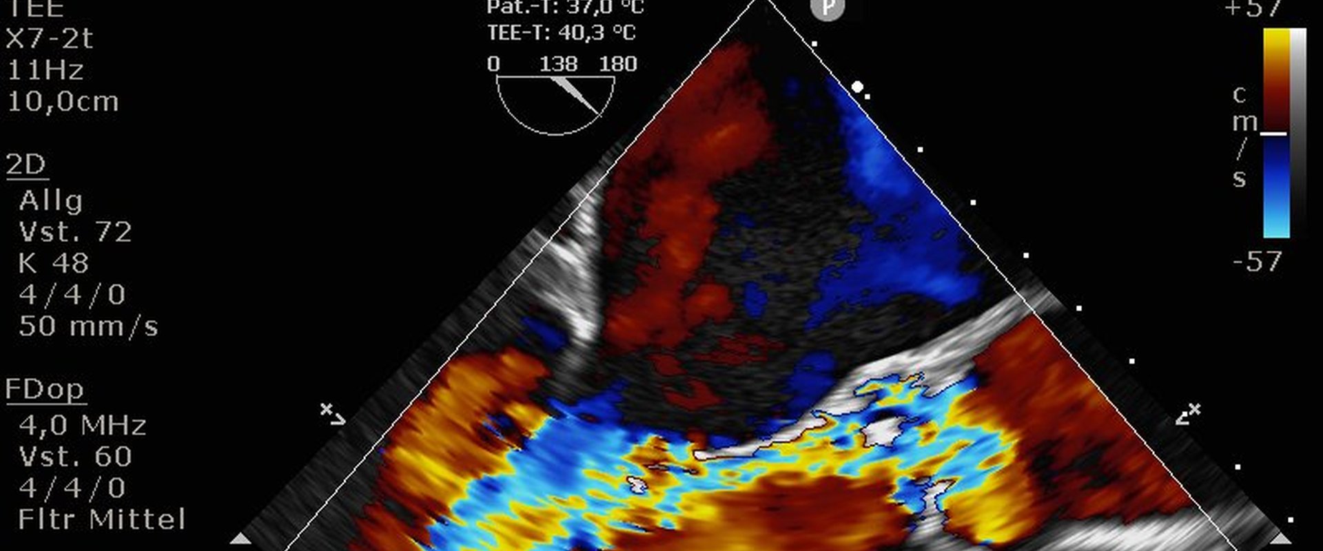 Aorteninsuffizienz_2