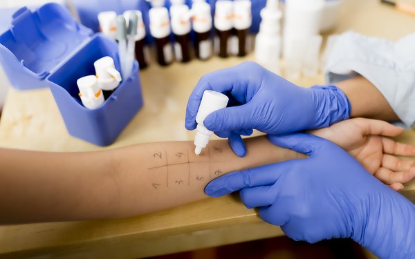 Allergiehauttest am Arm
